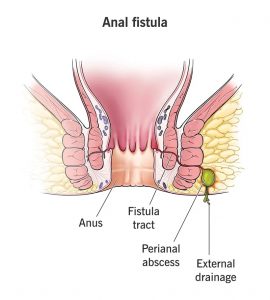 best Ayurvedic Fistula Treatment
